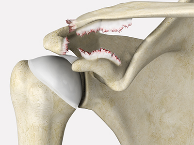 AC Joint Separation - Educational Picture