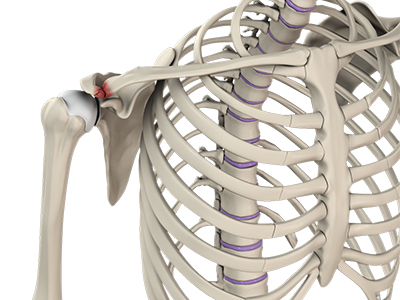 Acromioclavicular (AC) Joint Injuries - Educational Picture