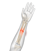 Adult Forearm Fractures Image