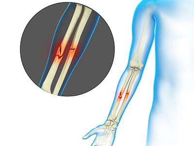 Adult Forearm Fractures - Educational Picture