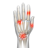 Arthritis of the Hand & Wrist Image