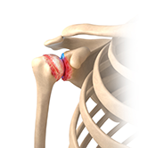 Arthritis of the Shoulder Image