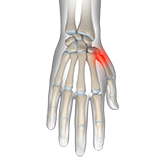 Arthritis of the Thumb Image