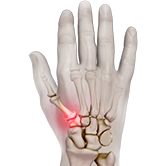 Arthritis Surgery for Thumb and Digit Image