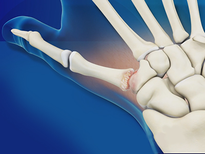Arthritis Surgery for Thumb and Digit - Educational Picture