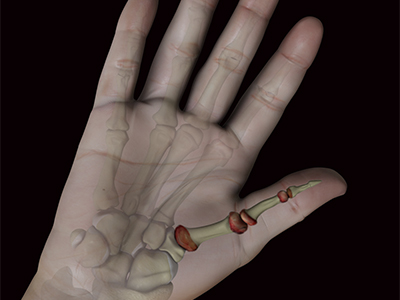 Thumb Arthritis Treatment - Educational Picture