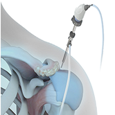 Arthroscopic Acromioplasty