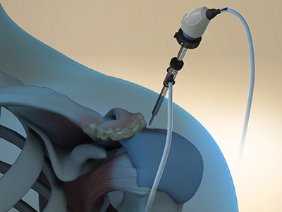Arthroscopic Acromioplasty - Educational Picture
