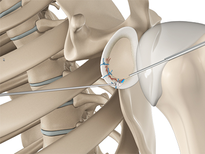 Arthroscopic Bankart Repair - Educational Picture