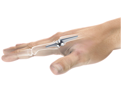 Artificial Finger Joint Replacement - Educational Picture