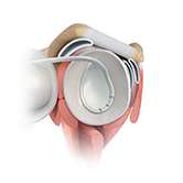Arthroscopic Bankart Repair