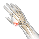 Bennett's Fracture Image