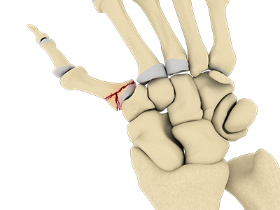 Bennett’s Fracture - Educational Picture