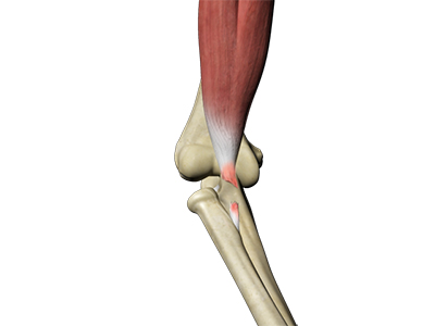 Frozen Shoulder - Educational Picture