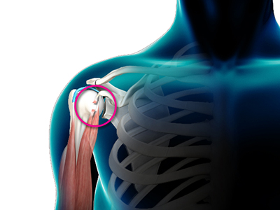Biceps Tendon Rupture - Educational Picture