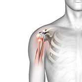 Biceps Tendon Rupture Image