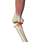 Biceps Tendon Tear at the Elbow Image