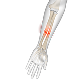 Both Bone Forearm Fractures Image