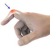 Boutonniere Deformity Image