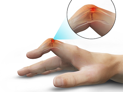 Boutonniere Deformity - Educational Picture