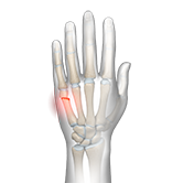 Boxer's Fracture Image