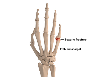 Boxer’s Fracture - Educational Picture