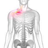 Brachial Plexus Injury Image