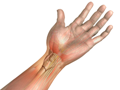 Broken Wrist - Educational Picture