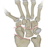 Carpal Instability Image