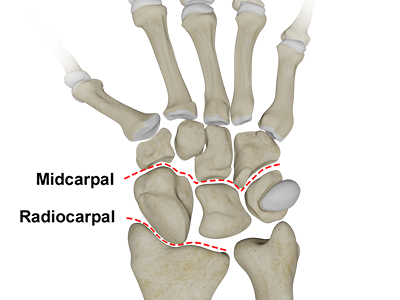 Carpal Instability - Educational Picture