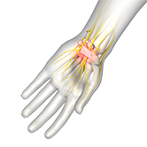 Carpal Tunnel Release Surgery Image