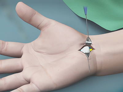 Carpal Tunnel Release Surgery - Educational Picture