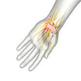 Carpal Tunnel Syndrome Image