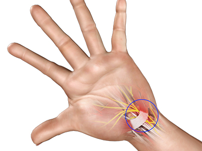 Carpal Tunnel Syndrome - Educational Picture