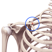 Clavicle Fracture (Broken Collarbone) Image