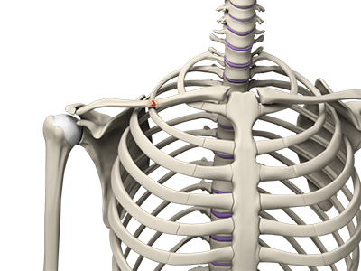 Clavicle Fracture (Broken Collarbone) - Educational Picture