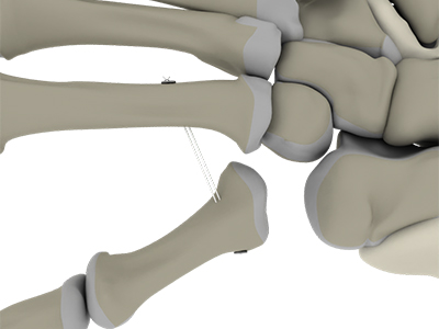 CMC Arthroplasty with TightRope - Educational Picture