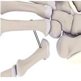 CMC Arthroplasty with TightRope Image