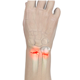 Complex Wrist and Hand Fractures Image