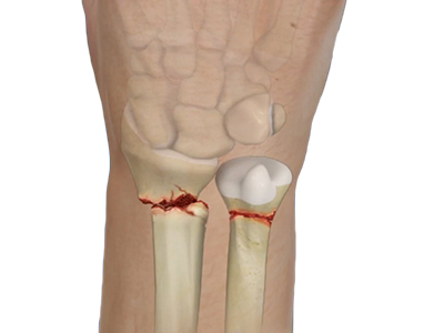 Complex Wrist and Hand Fractures - Educational Picture