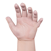 Congenital Defects of the Hand and Wrist Image