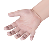 Congenital Hand Deformities Image