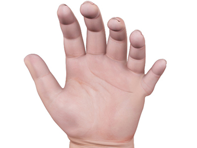 Congenital Hand Deformities - Educational Picture