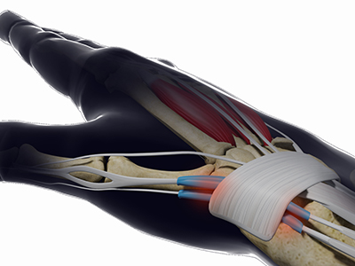 De Quervain's Tendonosis - Educational Picture