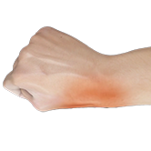 De Quervain's Tendonosis Image