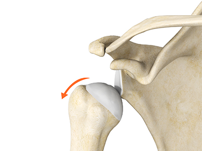 Dislocated Shoulder - Educational Picture