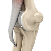Distal Biceps Repair Image