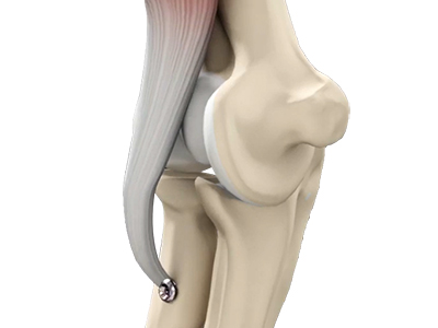 Distal Biceps Repair - Educational Picture