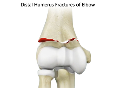 Distal Humerus Fractures of the Elbow - Educational Picture