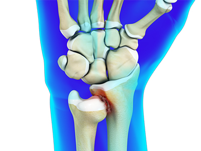 Distal Radioulnar Joint Arthritis - Educational Picture